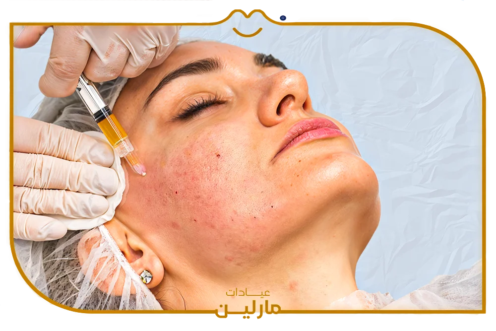 حقن البلازما PRP