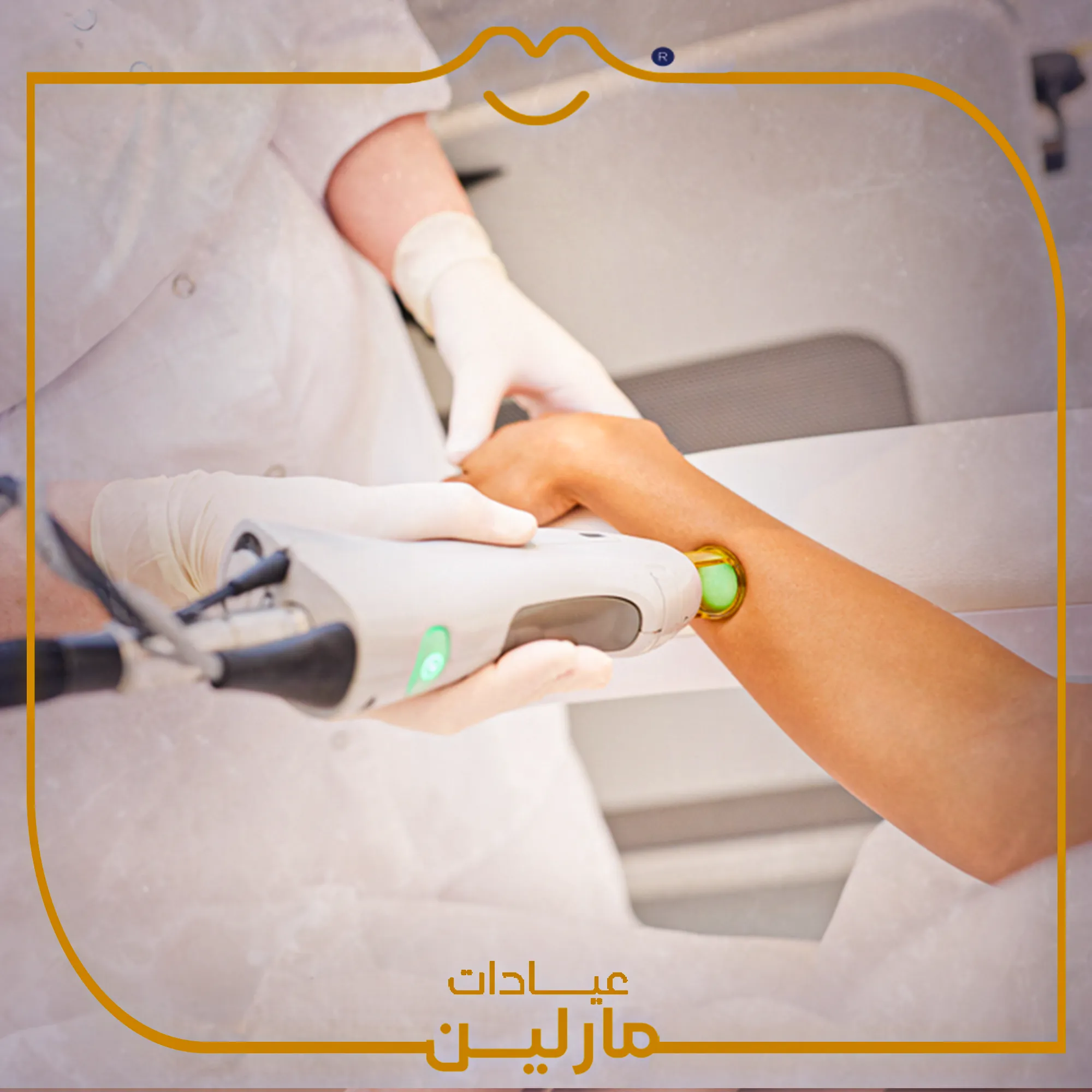 إزالة الشعر